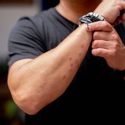 bed bug bites on skin