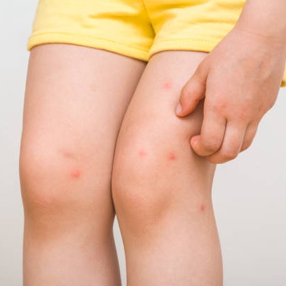 mosquito bites on skin